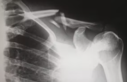 오십견 증상 오십견 치료방법