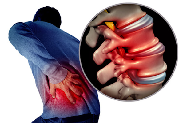 허리디스크 증상