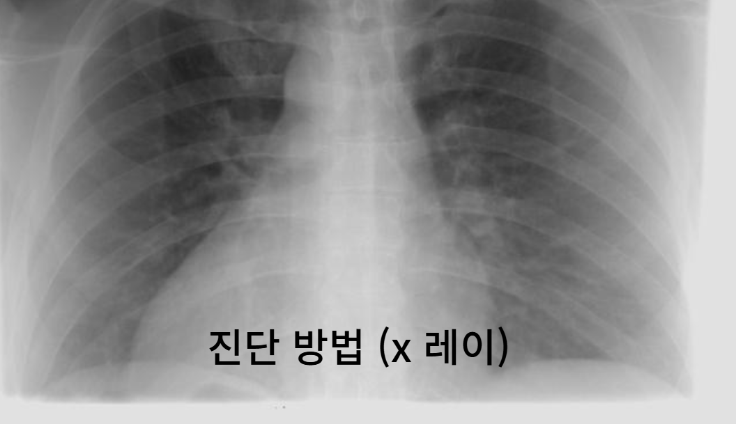 어린이 폐렴 진단 방법과 절차