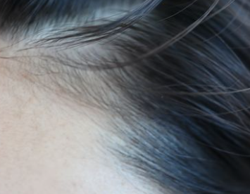 발모광(트리코틸로마니아) 원인과 치료 방법