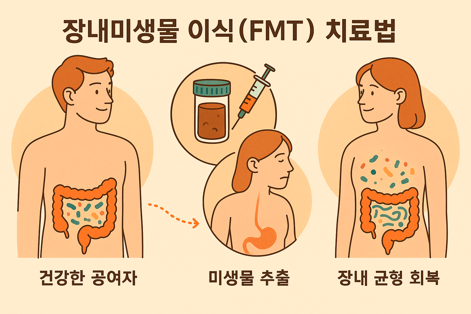 장내미생물 이식(FMT) 치료법 관련 사진