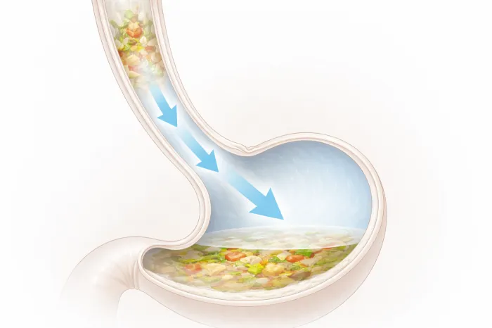 역류성식도염에 좋은 음식