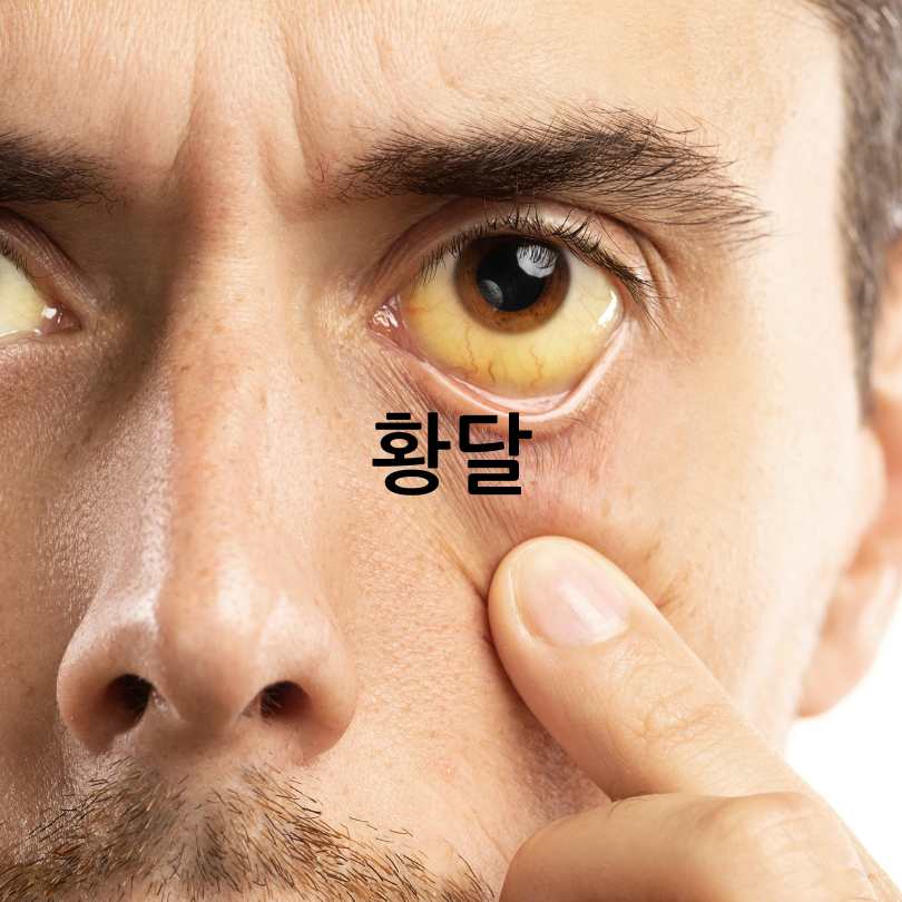 간수치 높으면 나타나는 증상과 낮추는 방법
