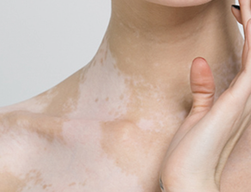 백반증 조기 치료