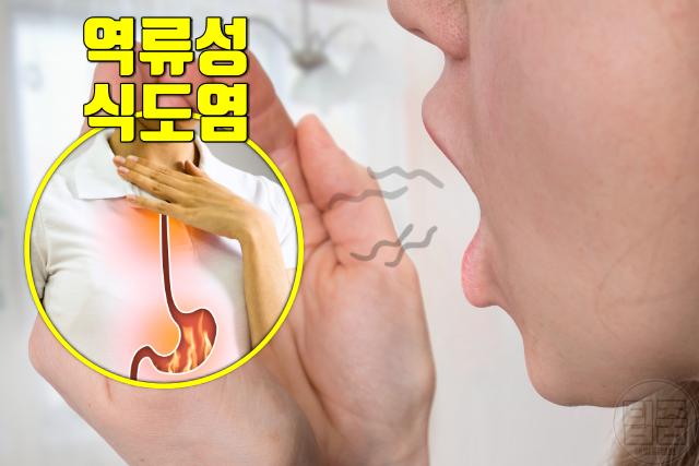 입냄새 심한 이유 입냄새 원인 질환 역류성식도염