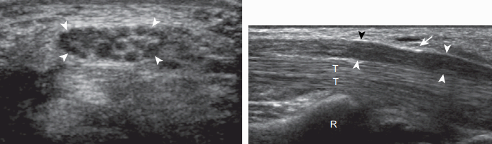 손목굴증후군(carpal tunnel syndrome)