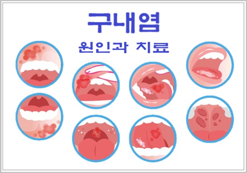 입 안 염증을 보여주는 사진