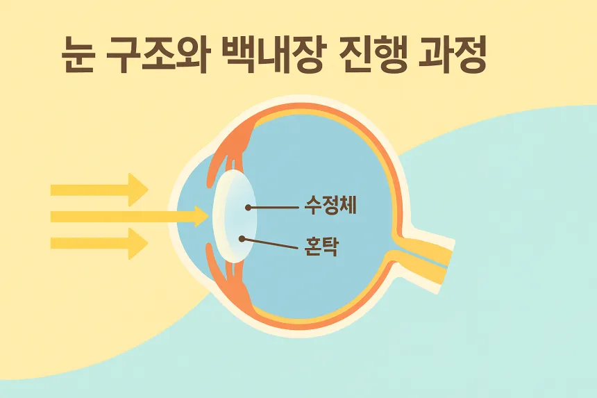 백내장