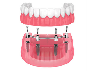 어금니 임플란트