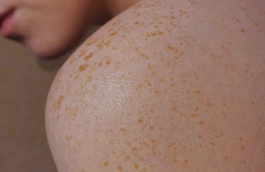 차가버섯 효능 : 피부