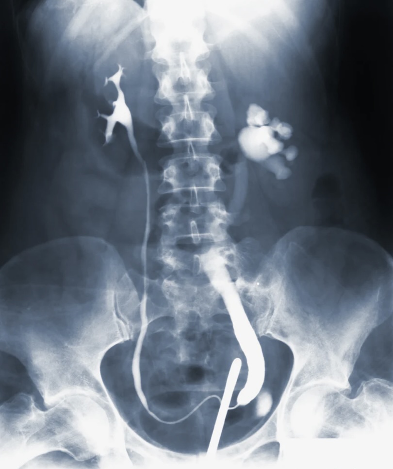 말기신부전증의 모든것