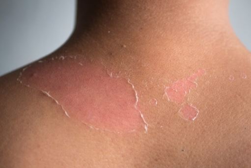 자외선에 노출되어 일광화상을 입은 피부사진