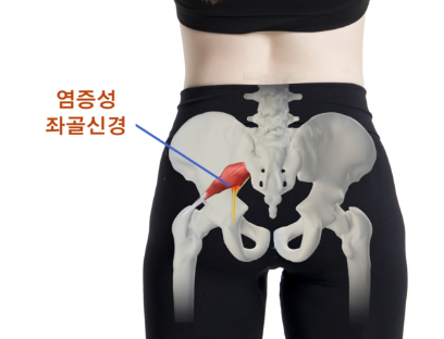 염증성 좌골신경
