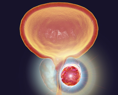 전립선암 치료법
