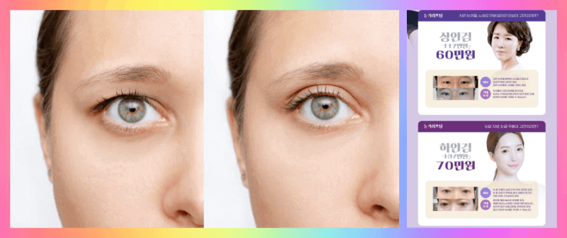 상안검 하안검 수술 비용