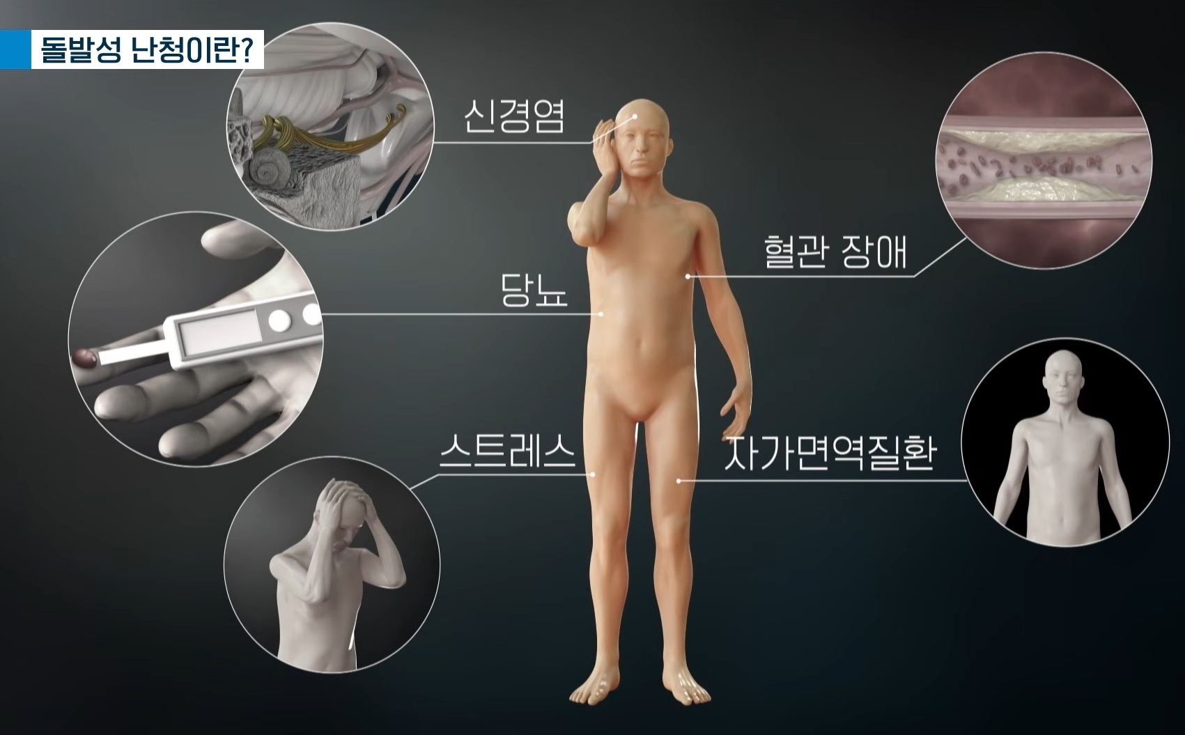 EBS-명의-난청-임기정-교수