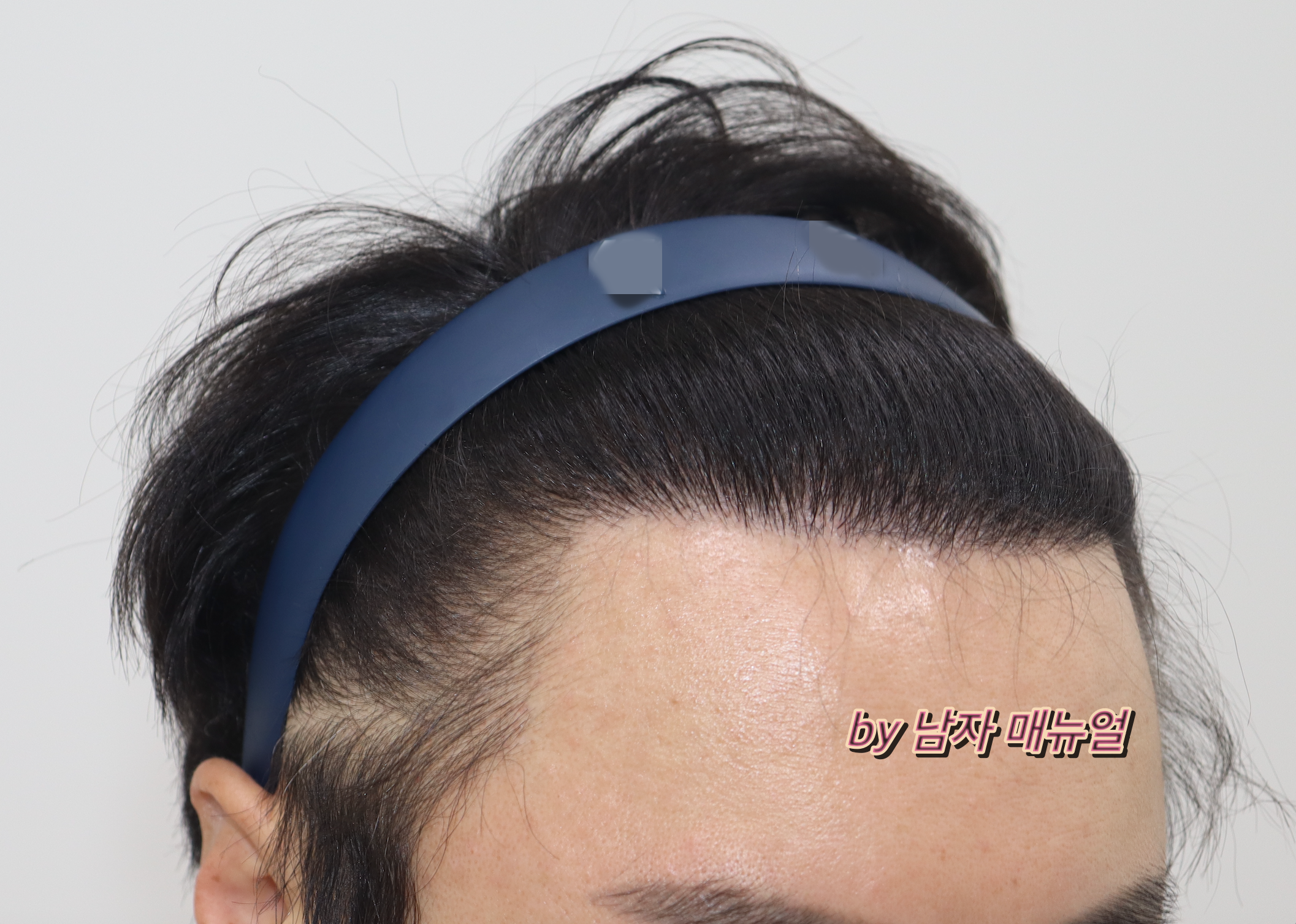 모발이식-후기-사진