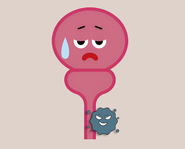 요로-종양-모습