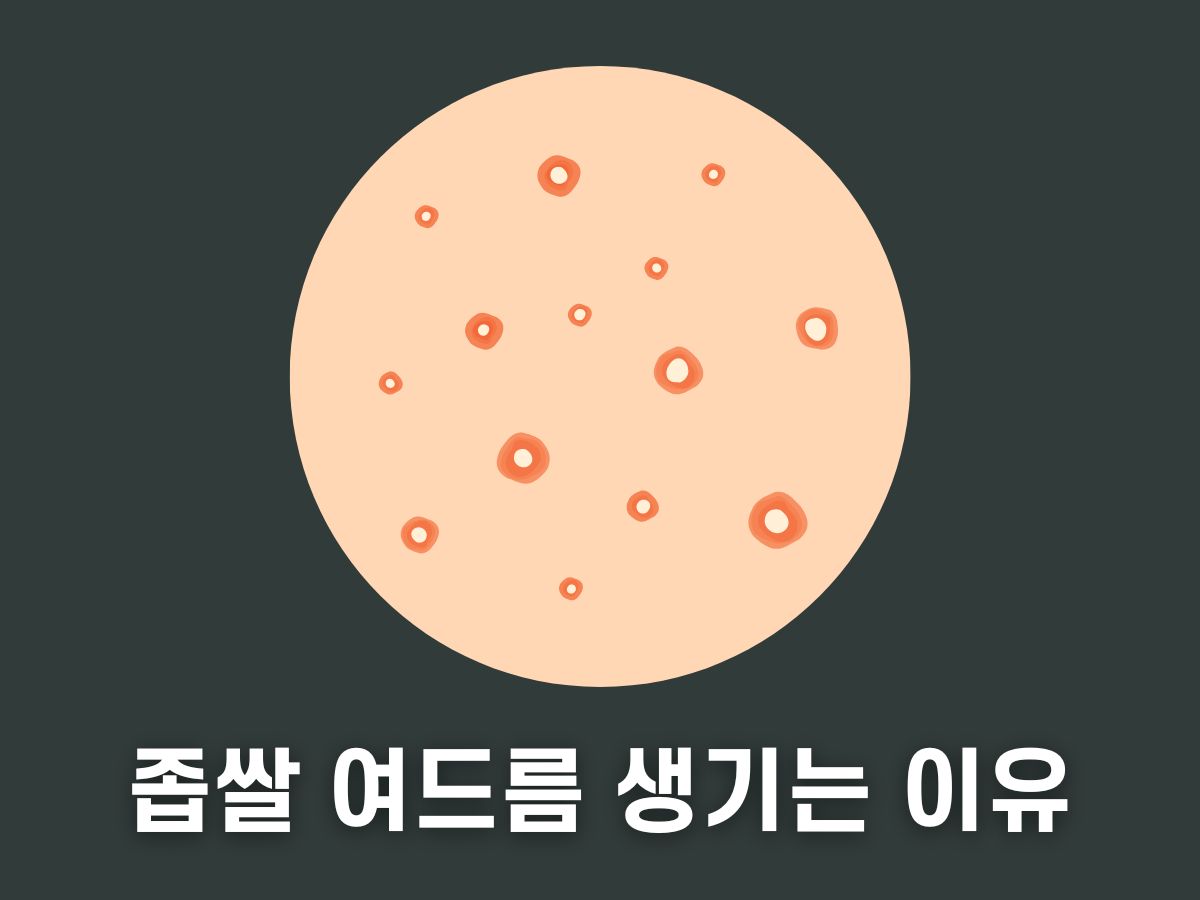 좁쌀 여드름 생기는 이유