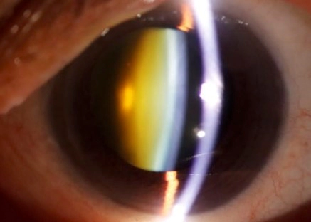 백내장 수술 후 시력회복 기간