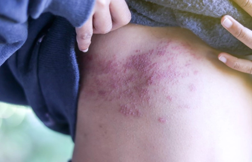 대상포진 전염성