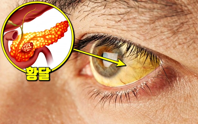 췌장암 증상 얼굴 눈흰자 노란색,췌장암 초기증상,췌장암 자가진단