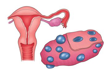 다낭성난소증후군
