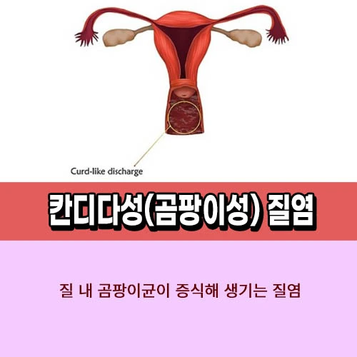 칸디다성 질염