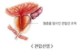 전립선염이란?