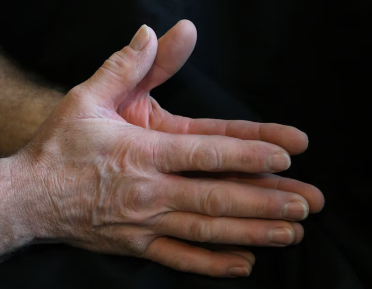 손등을 클로즈업한 이미지, 혈관과 피부색이 잘 드러남