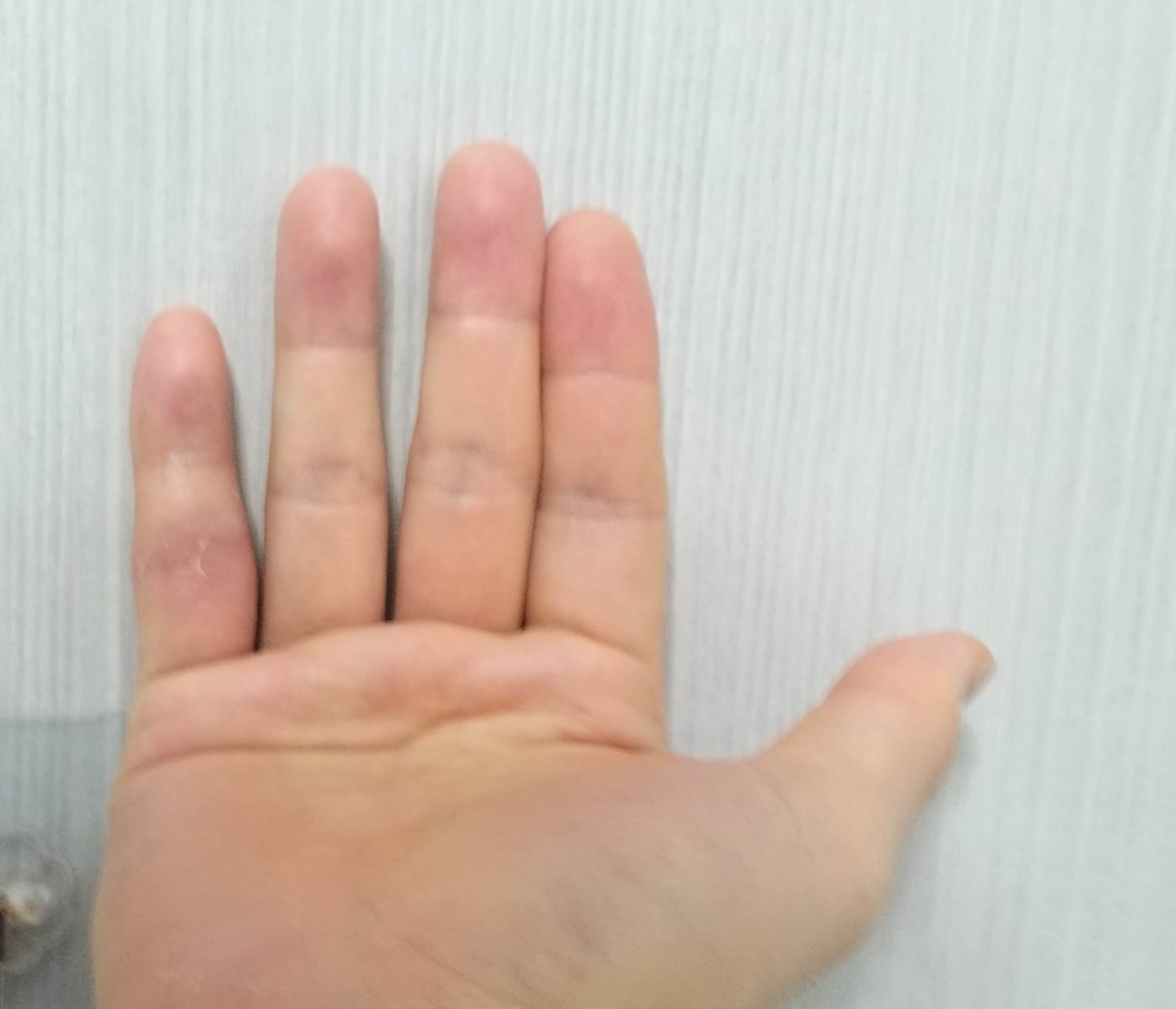 2월8일손가락구부림정도사진1