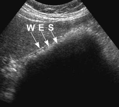 담석증 (Cholelitiasis = GB stone)