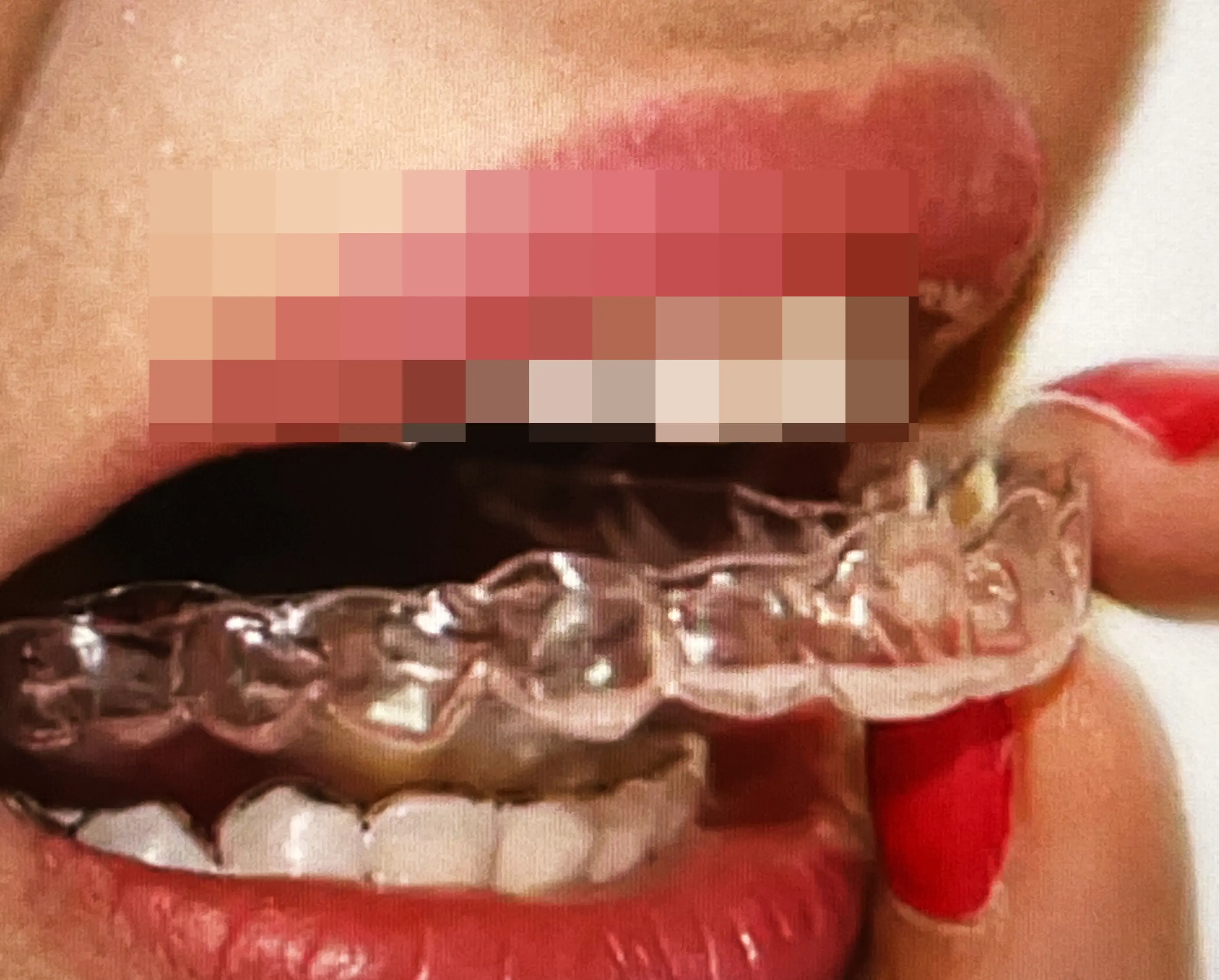안면-비대칭-교정-장치-스플린트-사진-2