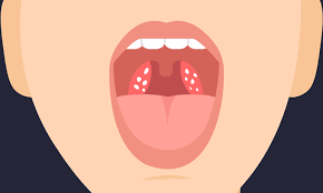 목에 이물감 느껴지는 증상