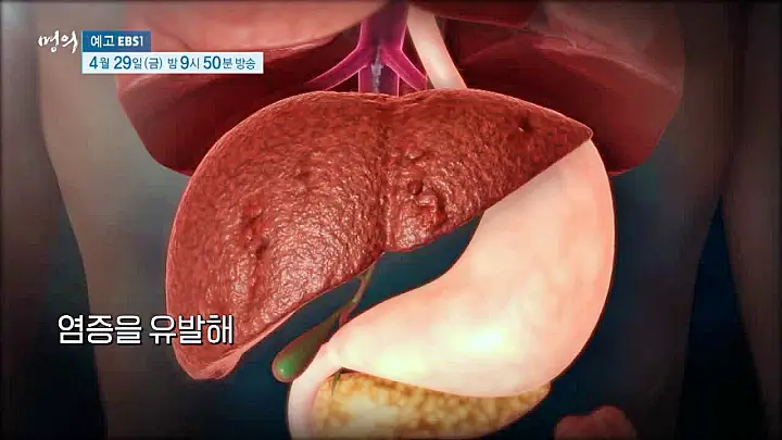 명의 지방간의 경고 저탄수 다이어트로 지방간 클리닉 탄수화물로 살찐 간이 위험하다