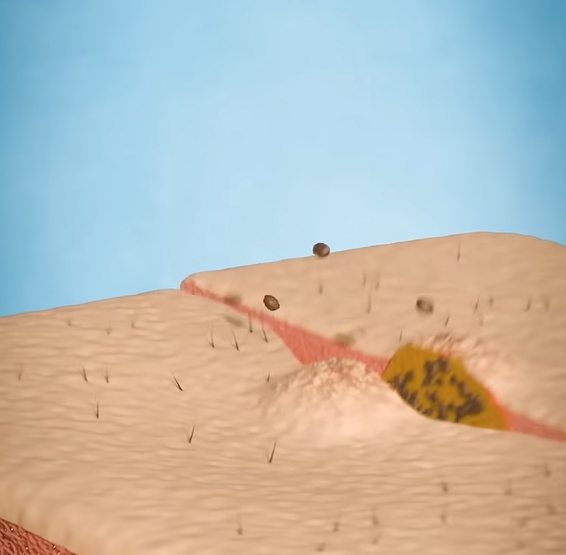 곤지름 초기증상