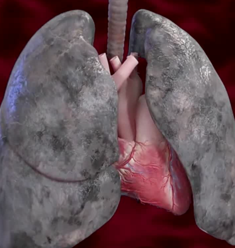 담배로인해썩은폐사진