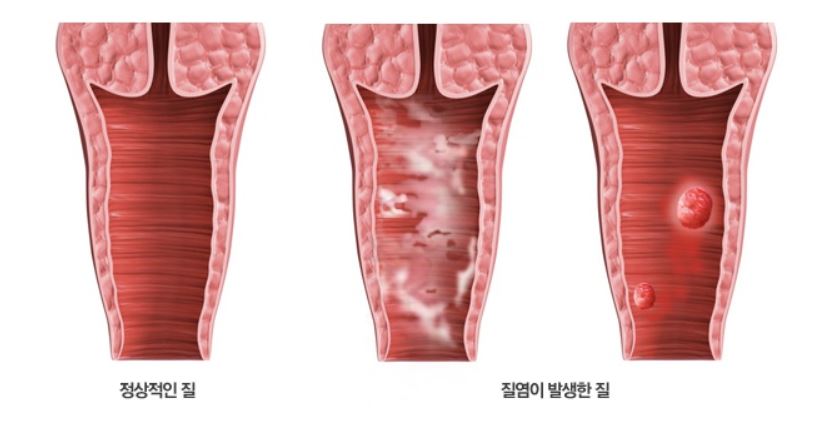 정상적인 질과 질염이 발생한 질