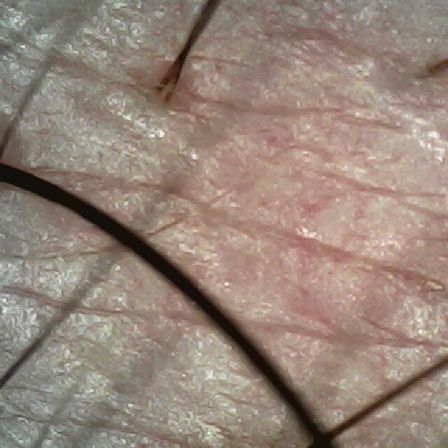 오른쪽 M자 부위 두피 모습이다.