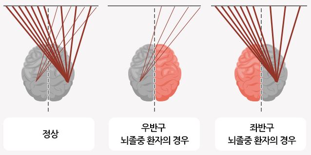 정상-뇌와-뇌졸증-환자-뇌