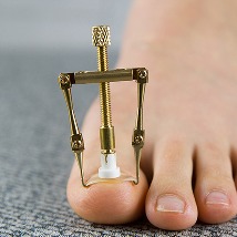 내성발톱 자가치료