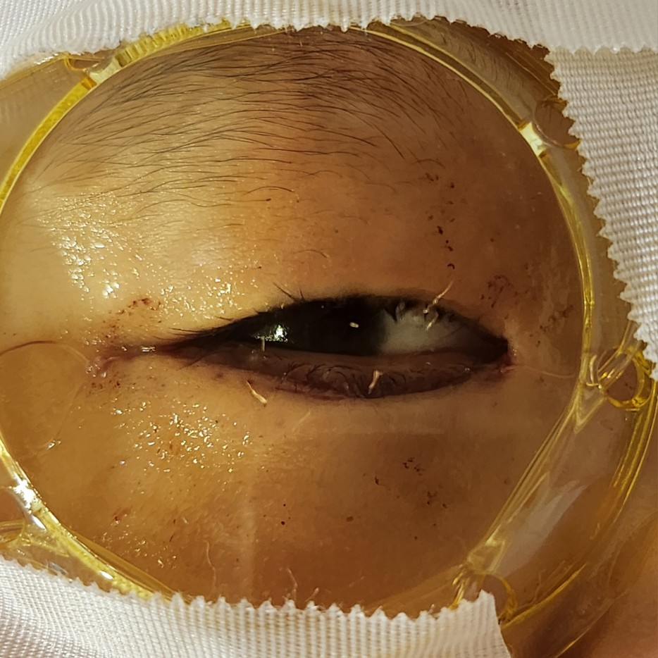 수술 당일 눈
