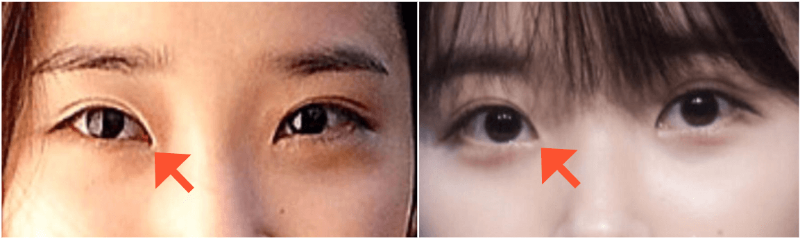 아이유-몽고주름