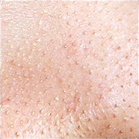 모공 피지 제거 전