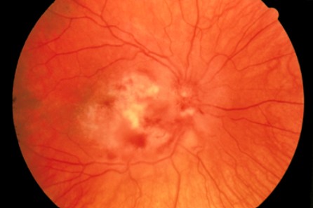 유리체 출혈된 모습