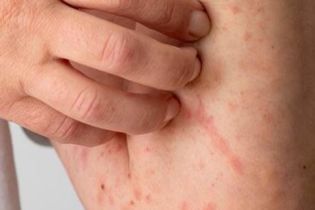 가려운-두드러기