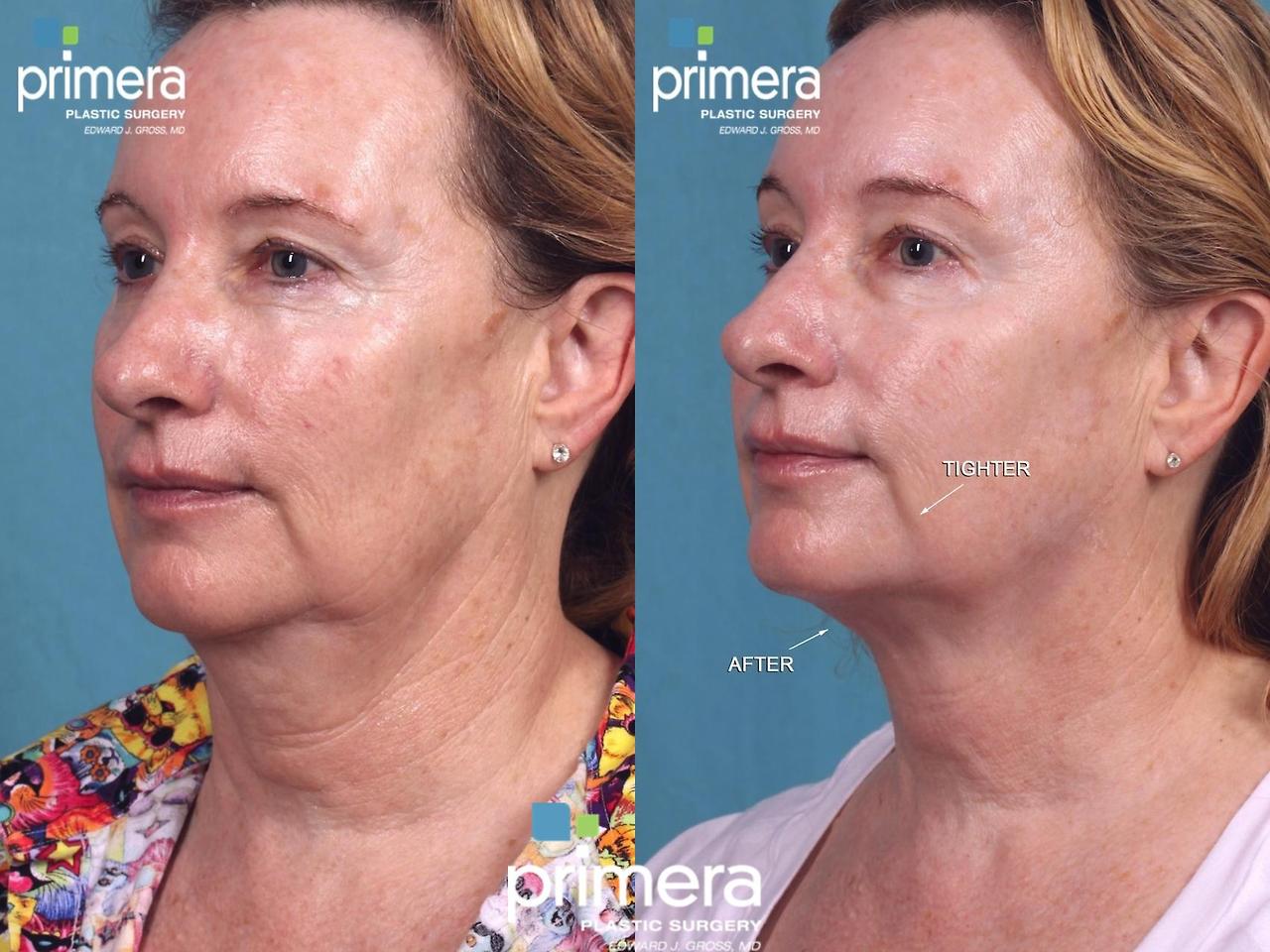 울쎄라 써마지 &mdash; 원리&middot;효과&middot;차이 완전 비교