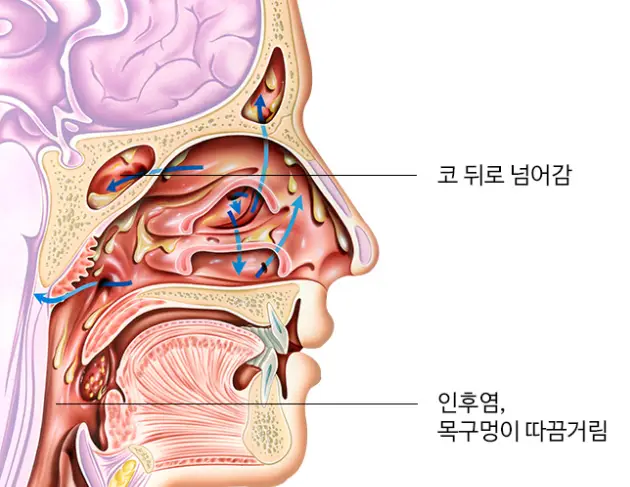 후비루-증후군이란