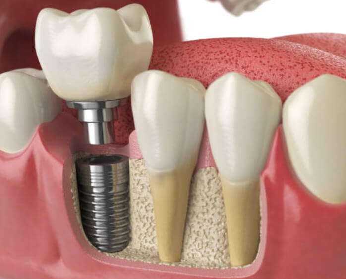 임플란트 시술비용
