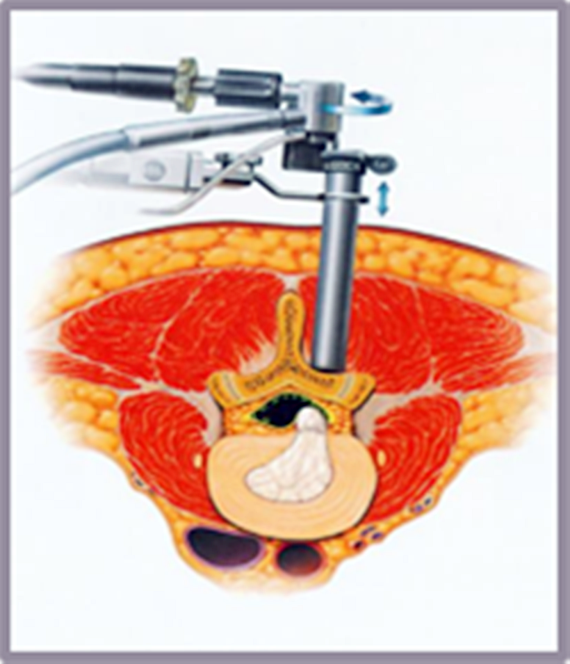 미세 현미경 수술 vs 내시경 수술 장단점